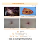 담낭종괴수술후기. 이틀후부터는 샤워도 가능하고 소독도 챙길 필요가 없어 수술회복이 더딘 나이드신 분이라면 더욱 추천... 이미지