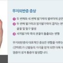 엄지발가락 통증 무지외반증 증상 원인 이미지