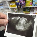 열우물로50번길 | [임신일기1] 임신극초기 증상, 쌍둥이 아기집, 다태아 임신확인서, 쌍둥이라고요?