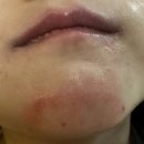 아이소잉 | 유아 턱교정 아이소잉 페이스마스크 커버 내돈내산 솔직 후기
