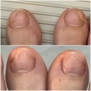 망포지하차도 | [수원] 레푸스 수원망포 : 무좀발톱 스케일링 후기