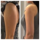 [공지] 복부 러브핸들 람스 당일 후기! 붓기, 통증, 멍 솔직후기