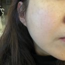봄약국 | 압구정 라움 성형외과 후기 흑자 루비레이저 치료 2년 전 부분 효과 보고 전체 다 하게된 이야기