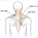 근막동통 증후군[myofascial pain syndrome] 이미지