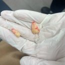 길치과의원 | 강남 사랑니 발치 잘하는 곳 추천: 제트구강악안면외과치과의원 후기