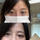 민의원 | 민클리닉 듀얼다크주사 다크서클 레이저 내돈내산 리얼 후기