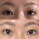 아싸리 | 세미아웃라인 비절개 자연유착+눈매교정+눈두덩이 지방제거 한달차 내돈내산 리얼후기