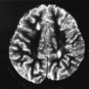 급성 파종성 뇌척수염[acute demyelinating encephalomyelitis, ADEM] 이미지