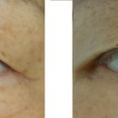 대구눈성형-브이성형외과 상안검성형술(눈처짐수술) 특징[대구쌍꺼풀] 이미지