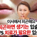 구각염 구순염 원인 예방 이미지