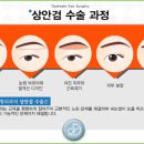 상안검수술비용 상안검수술은 꼼꼼하게! 이미지