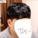 사례 | 남성부분가발,실제 착용 사례 후기
