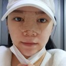 박준목장 | 끄적끄적17_복코성형_코수술7일차_실밥,부목제거_코수술전후사진