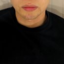 스노우의원 | 노원역 제모ㅣ노원 젠틀맥스프로플로스, 스노우의원 리얼 후기 (내돈내산 2회차)