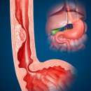 The나은약국 | 역류성식도염 약 3년 먹었는데.. 이거 알고 끊었습니다.