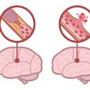 뇌졸중 전조 초기 원인 예방 좋은음식 이미지