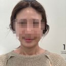 킨텍스아는약국 | [킨텍스 피부과] 얼굴살없는 30대 인모드 fx 내돈내산 효과/부작용 모두!