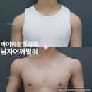 남자 어깨필러 전후사진으로 보는 실제 변화 — 옷태가 달라지는 순간 | 바이미성형외과