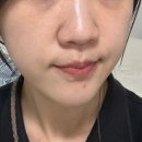 진주사 세탁소 | 대구 동성로 피부과 연어주사 스킨부스터 염증 피부 결과후기