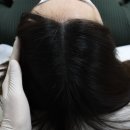 나는 소년이었다 SMP | 합정탈모커버 나는 소년이었다 SMP