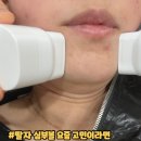 또팔자 | 팔자주름리프팅부터 심부볼 이중턱까지 네오스컬프 1회차 솔직 후기
