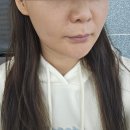 수경피부과 | 대구 쥬베룩 볼륨 동성로 피부과 2차 후기