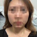 강남피부과 가성비 울써마지 브이로리프팅후기