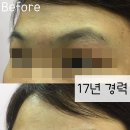 더블류성형외과 네이버블로그