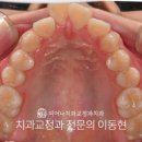 정인치과의원 | 원당동 교정치과 | 뻐드러진 앞니, 교정치료로 심미적이게