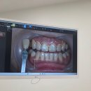 미백 | 신사역 치아미백 후기 레브치과 내돈내산 전후비교