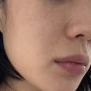 K마디병원 맞은편 | 이수역 피부과 올리지오 효과 300샷 솔직 후기