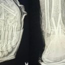 서울 유명 정형외과서 왼발 수술인데 오른발 절단하고 수술 이미지