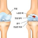 엄지손가락 통증 저림 원인과 이미지