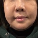 31140-14-20-18 | 안면윤곽 3종+앞턱전진+귀족수술 내돈내산 리얼 후기 2주차 [14일-20일] *부작용 있음