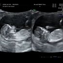 임신일기, 12주-14주차 기록 / 정밀초음파, 부산벡스코베이비페어, 태아보험가입