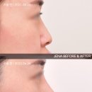 제나성형외과의원 | [코 성형] 서면 제나성형외과, 코 성형 후기 전후 ❤️