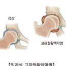 고관절 통증 원인, 일과성 고관절 활액막염 및 (아이 다리 절뚝거림) 이미지