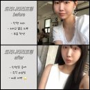 트리니티병원 | 강남 신사피부과 트리니티 리프팅 레이저 후기 | 리프팅 &amp; 미백 동시 효과