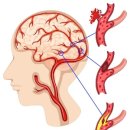 뇌졸중 이미지