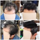 맞춤가발·증모술 없이 모류교정과 뿌리볼륨으로 남자 탈모를 극복시키는 미용실? '이것' 하나면 충분...