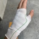 시원병원 | 뜨거운 물 화상 입었을 때 광주 화상전문병원 시원외과 치료 후기