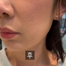 성형외과전문의 여드름흉터시술 울트라펄스알파 여드름흉터레이저 치료 1회차 솔직 후기