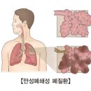 신종 폐질환[[Humidifier Disinfectant-Associated Lung Disease]] 이미지