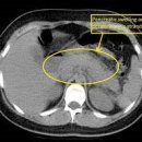 급성췌장염[acute pancreatitis] 이미지