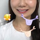 웃는얼굴 만들기 와이키키 미소교정기 전후비교 후기 웨딩준비 표정연습