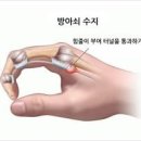 손가락 통증과 저림 방아쇠수지 증후군 증상과 치료 이미지