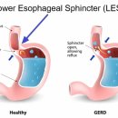 위산이 많을수록 더 건강합니다 이미지