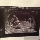 임신 12주+3일. 1차 기형아 검사 무사통과!! 이미지
