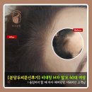더 올림(The Ollim) | 분당두피문신, 비대칭M자탈모, 올림머리 헤어라인문신으로 해결한 후기 (feat.두피공방)
