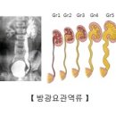 수신증 (Hydronephrosis) 이미지